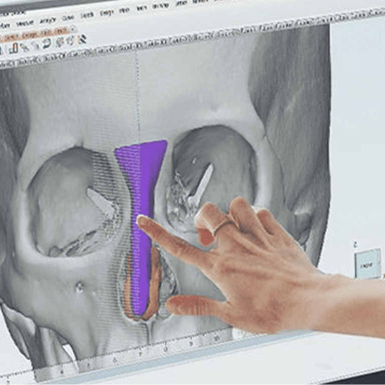 FITme (3D printing)
